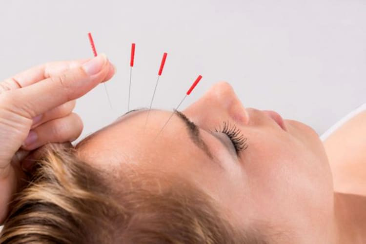 Châm cứu - kỹ thuật đòi hỏi chuyên môn cao để giảm đau nửa đầu trái