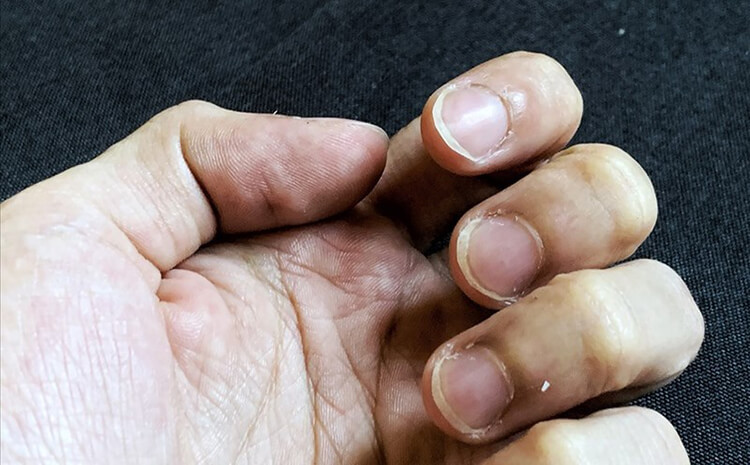 Móng tay giòn, dễ gãy là dấu hiệu của thiếu sắt