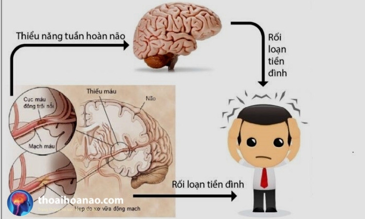 Nguyên Nhân Gây Rối Loạn Tiền Đình